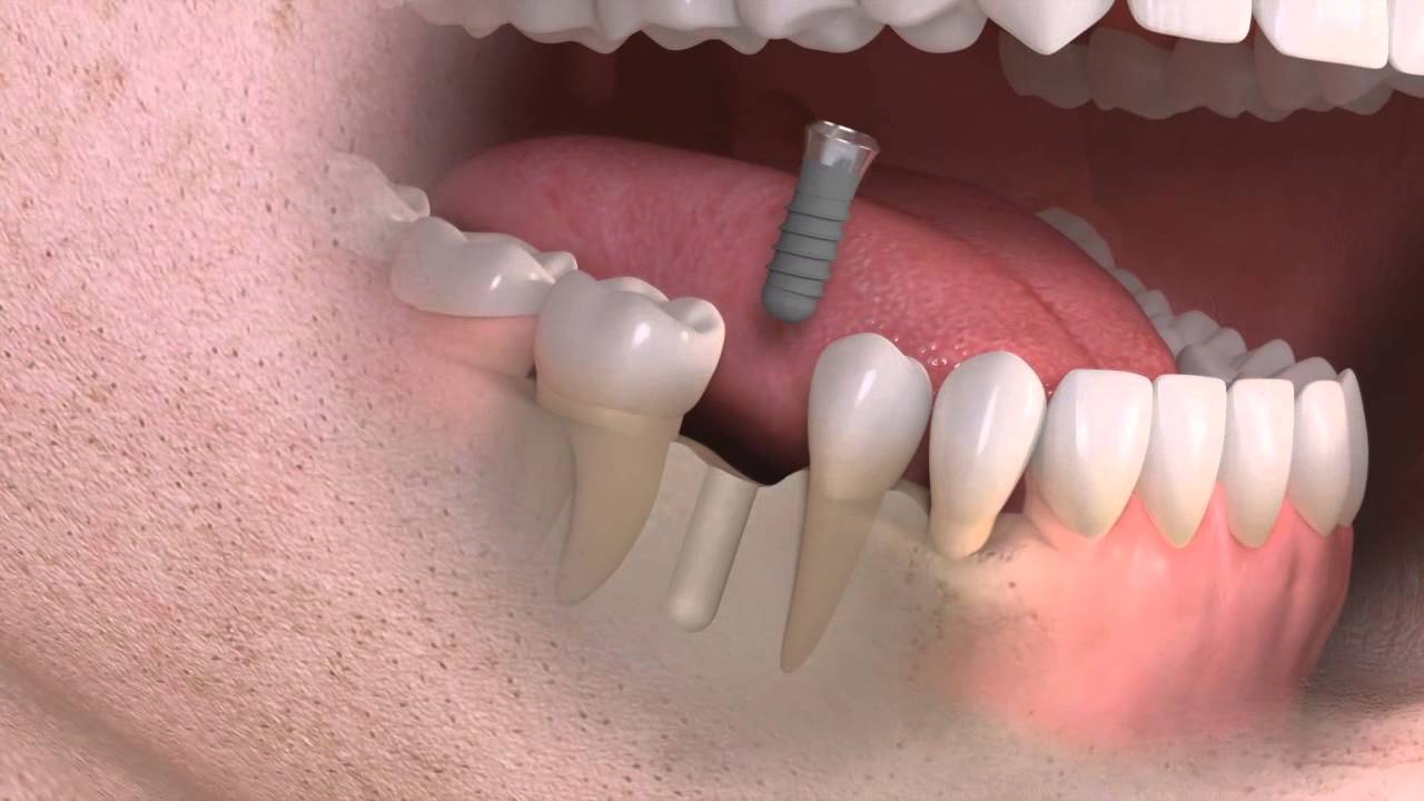 Ból po implantacji Ból zęba